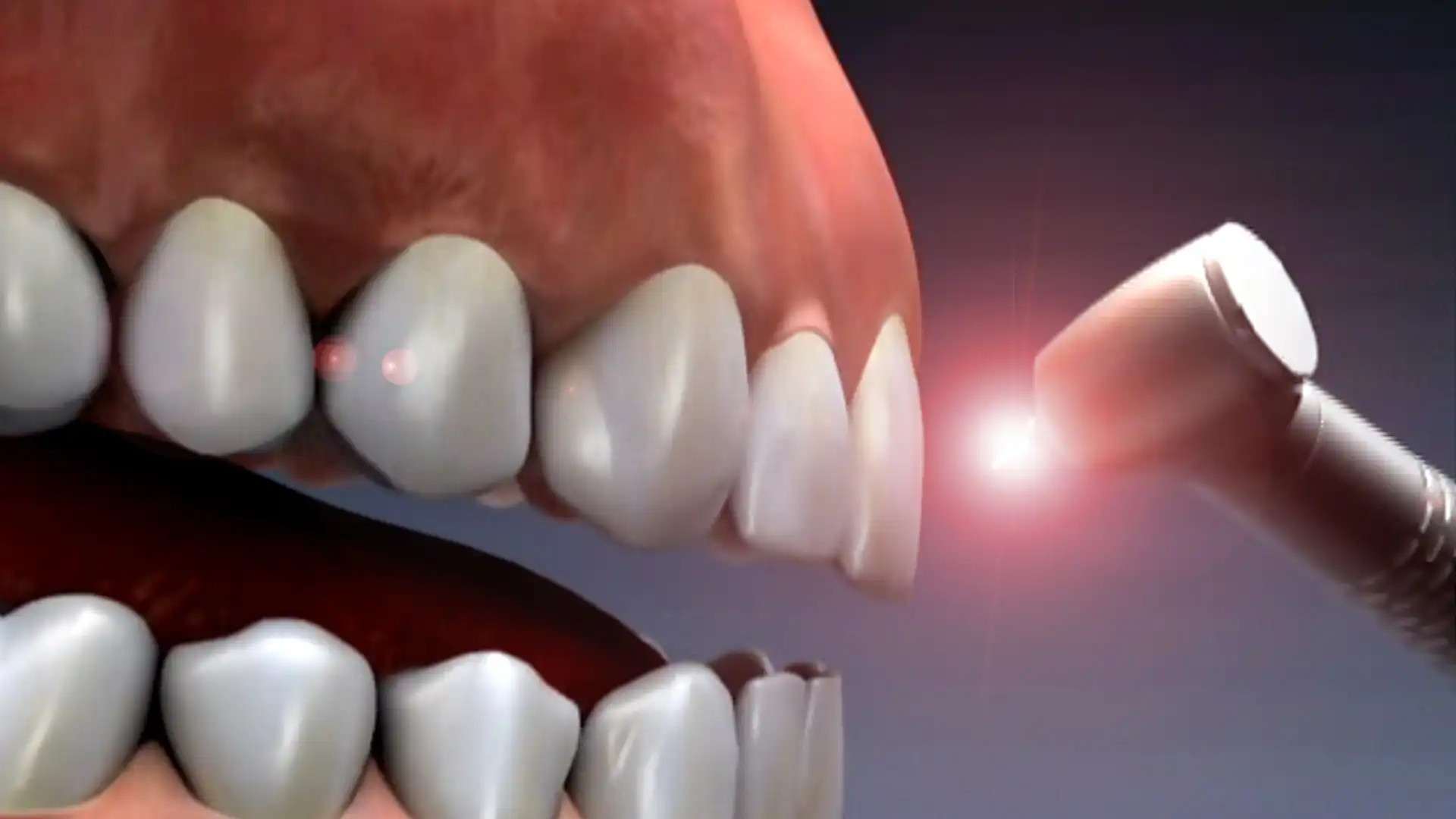 ارتودنسی دندان با لیزر