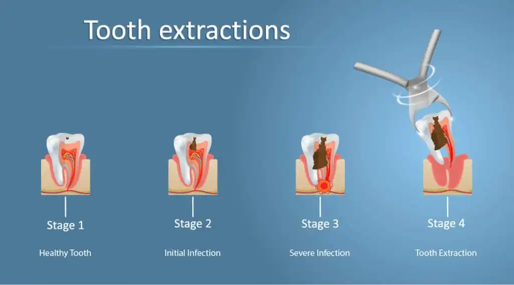 مدت زمان پر شدن جای دندان کشیده شده در ارتودنسی
