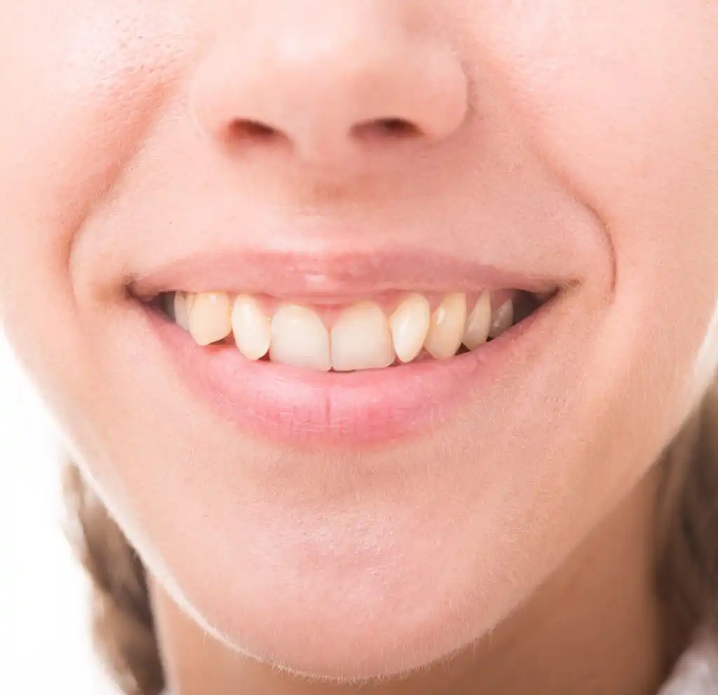 هزینه ارتودنسی یک دندان کج