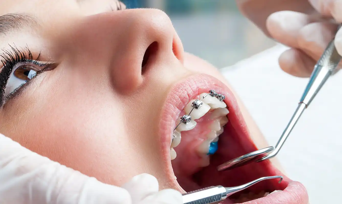 پوسیدگی دندان در ارتودنسی
