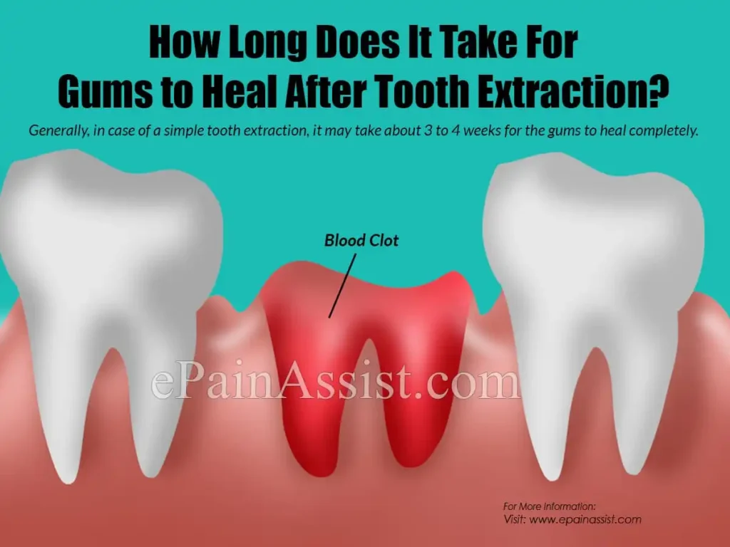 مدت زمان پر شدن جای دندان کشیده شده در ارتودنسی