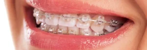 ارتودنسی با دندان خراب